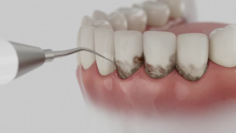 Reliable Dental Implants contractor in Fort Denaud, FL by Smile Center Dentistry